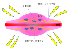 こりの図