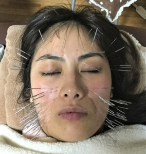 美容鍼